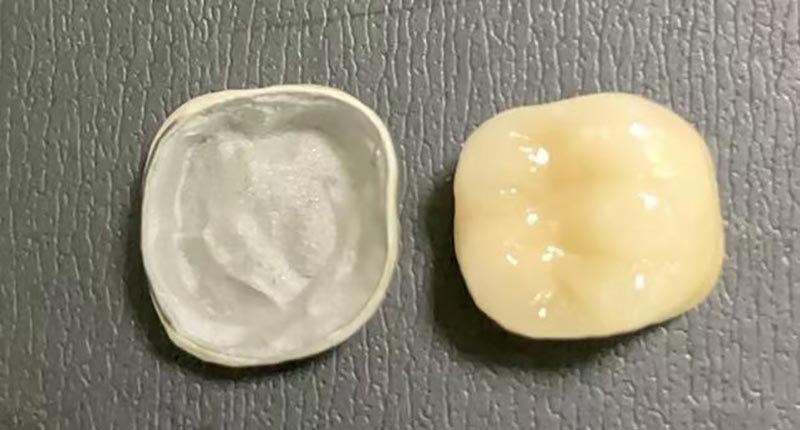 Что делать, если фарфоровая коронка раскололась? Вот почему это происходит и как это исправить