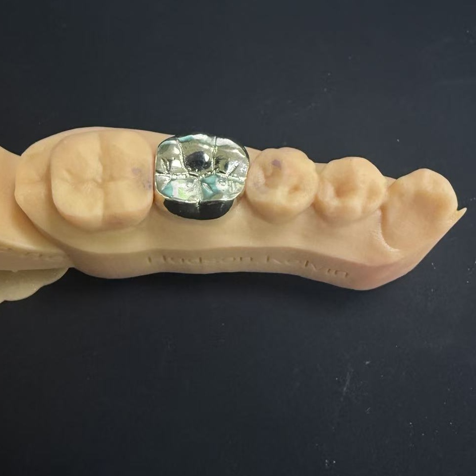 Золотые коронки: выбор драгоценного металла для пожизненной реставрации зубов