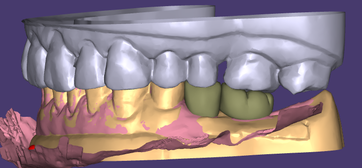 Эстетическая восковая модель и временные реставрации WM Dental Lab получили единодушное признание клиентов