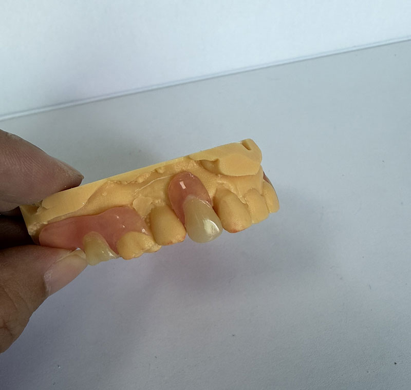 Valplast Partials в стоматологической лаборатории WM
