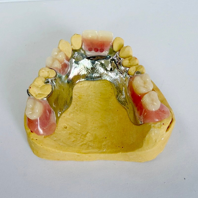 Съемный реставрационный частичный каркас